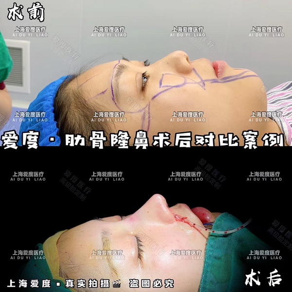 上海鼻整形医生