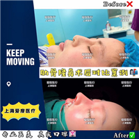 上海鼻整形医生