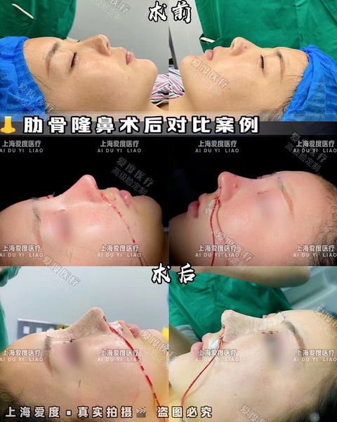 上海鼻整形医生