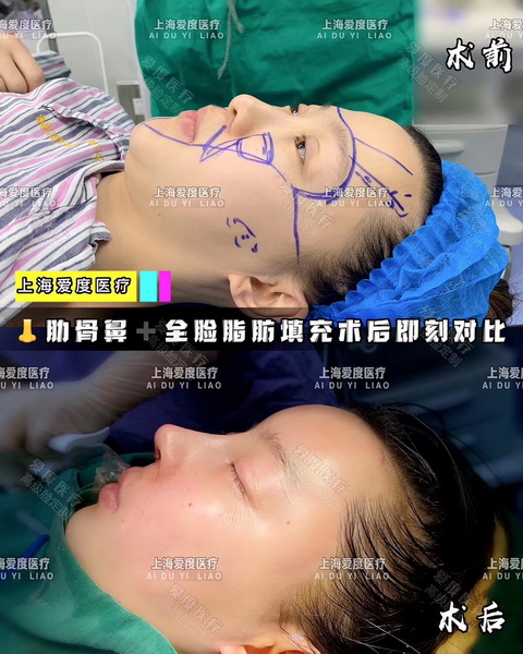 上海鼻整形专家
