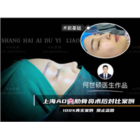 何世硕院长科普鼻整形该怎么避免鼻头挛缩