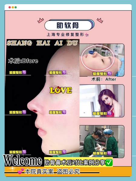 上海鼻整形专家