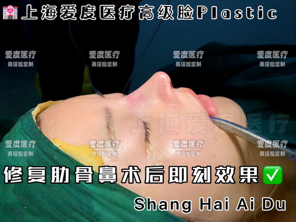 上海鼻整形修复