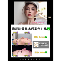 上海鼻整形专家