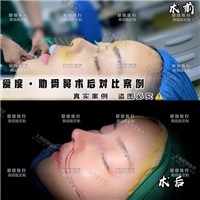 上海鼻整形医生
