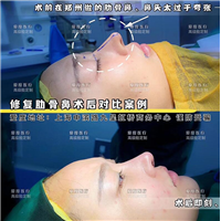 何世硕做鼻子怎么样 