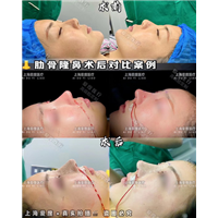 上海鼻整形医生