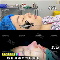 上海鼻整形修复