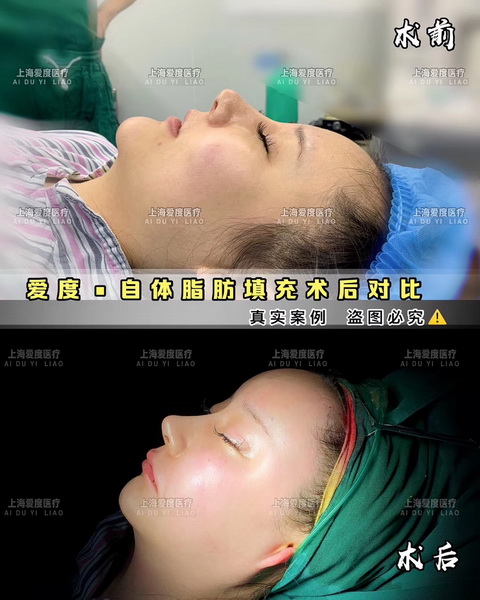 上海鼻整形医生
