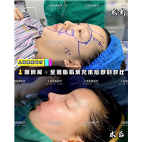 上海鼻整形专家