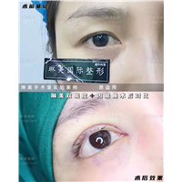 上海琳美国际双眼皮整形