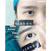 上海琳美整形眼综合