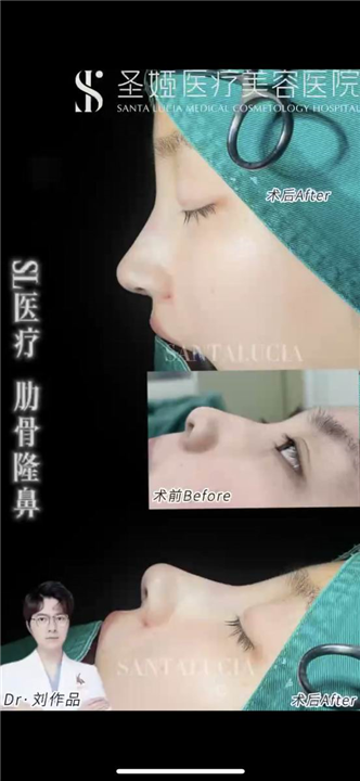 上海琳美腰腹环吸精雕术