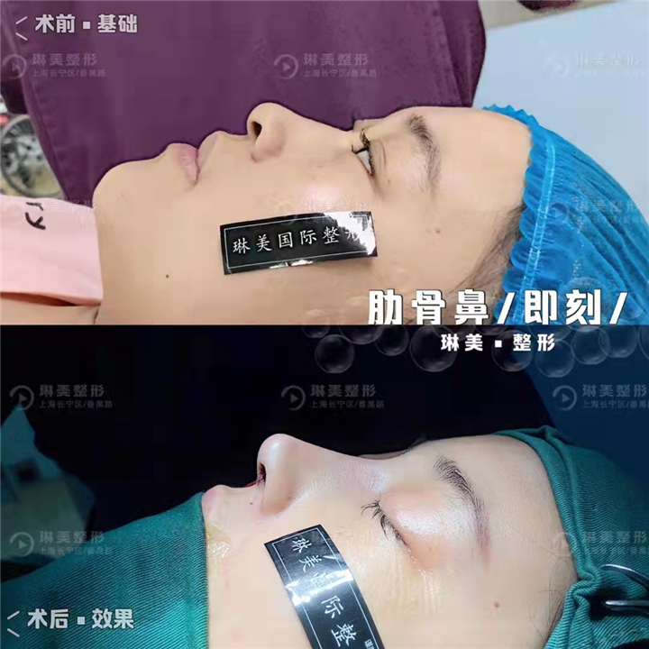 琳美肋骨鼻