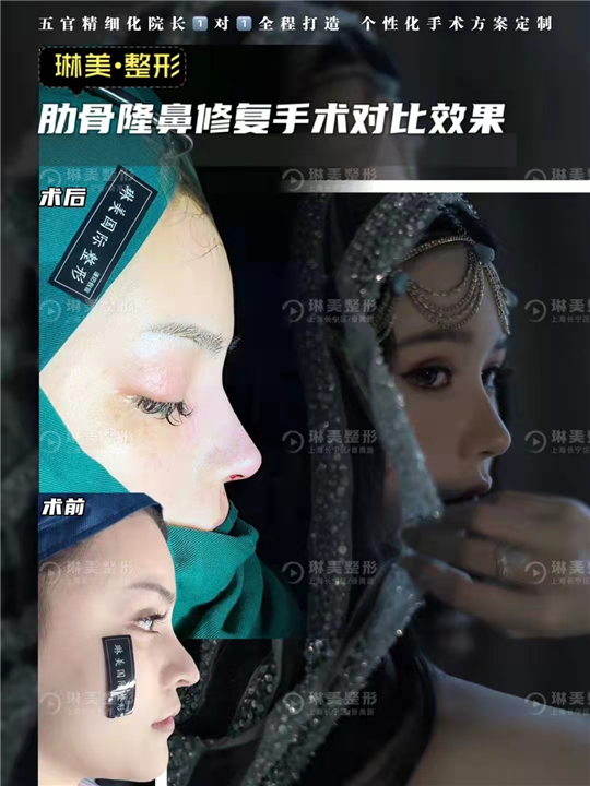 上海肋骨隆鼻修复手术