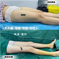 上海大腿环吸整形