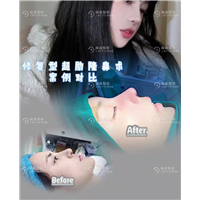 上海琳美修复型超肋隆鼻术