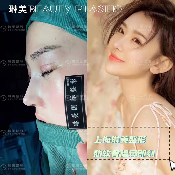 上海琳美肋软骨隆鼻