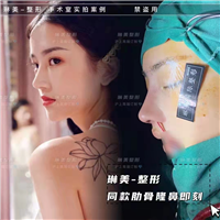 上海琳美整形肋骨隆鼻