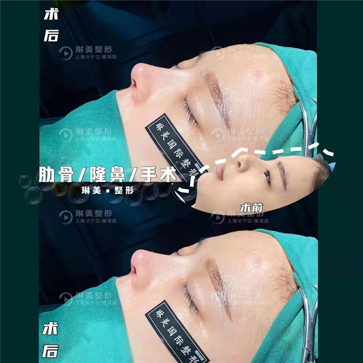 上海鼻综合整形哪家好
