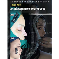 上海肋骨隆鼻修复手术