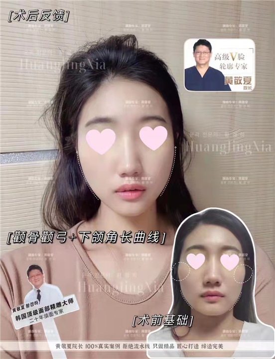 上海磨骨整形