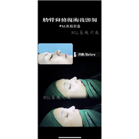上海黄敬夏磨骨案例