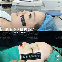 上海肋骨鼻整形多少钱