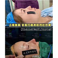 上海鼻整形