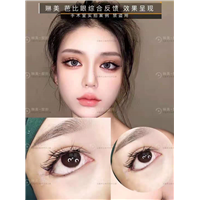 琳美国际芭比眼综合案例