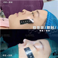 琳美肋骨鼻