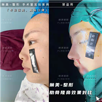 上海肋骨隆鼻整形