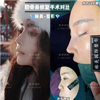上海琳美肋骨鼻修复整形