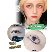 上海眼综合整形多少钱