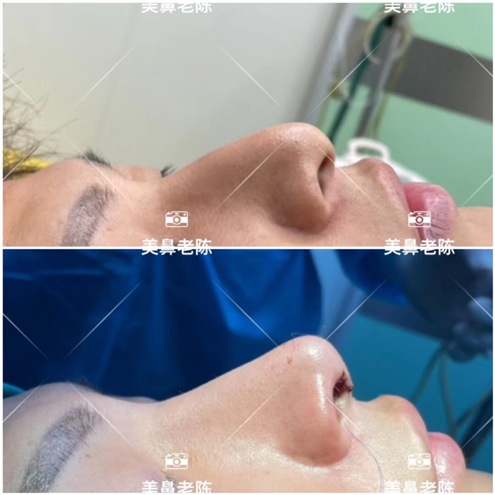 上海肋骨鼻修复医生
