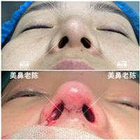上海鼻整形医生陈坚