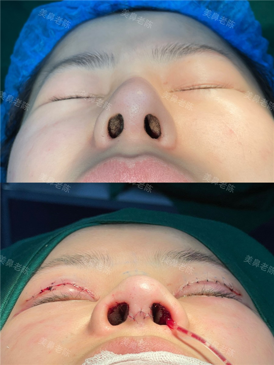 陈坚肋骨鼻修复