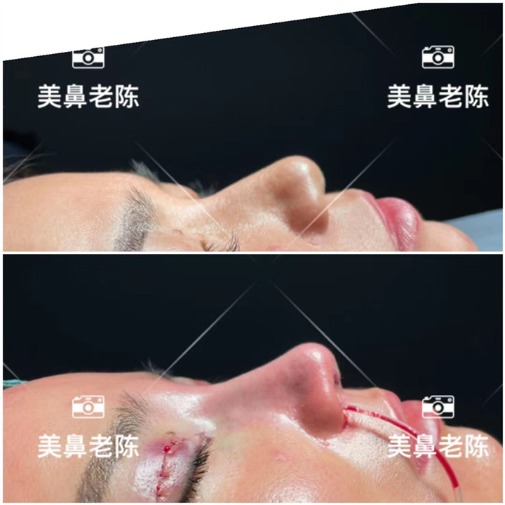 上海鼻王整形陈坚医生