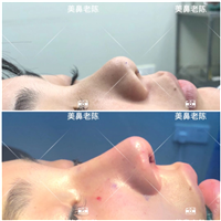 上海耳软骨隆鼻医生