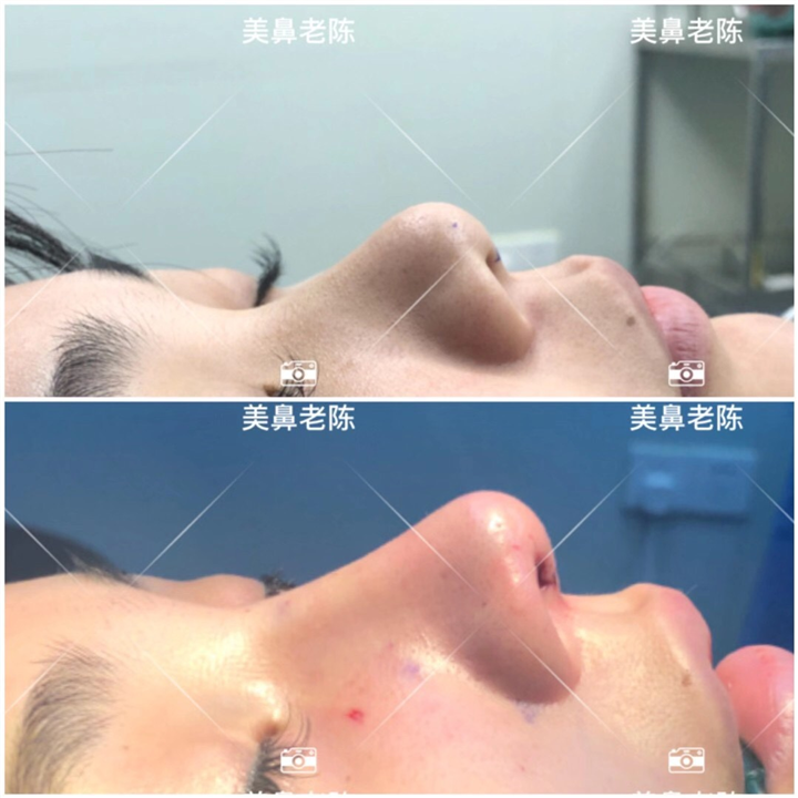 陈坚鼻整形修复
