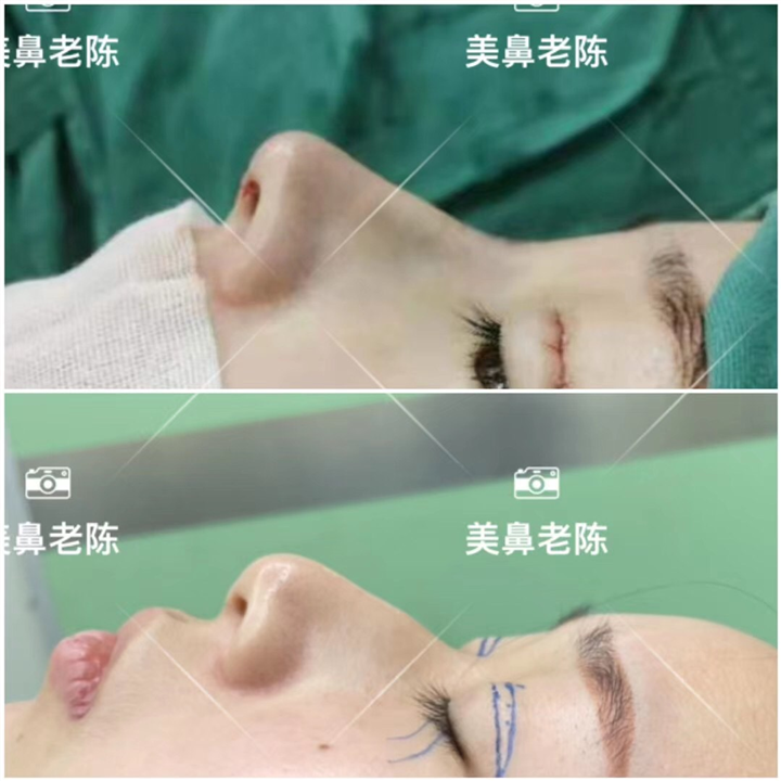 陈坚鼻整形