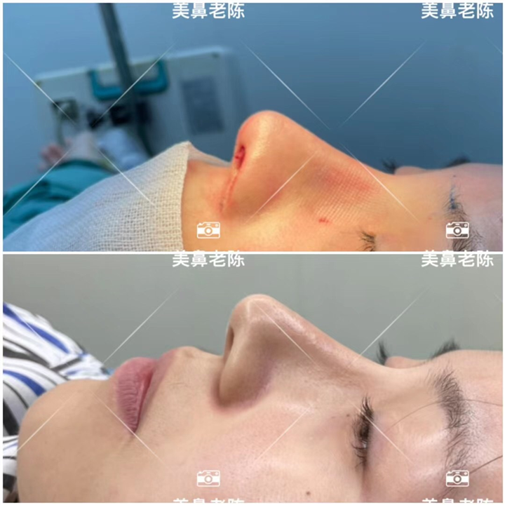 陈坚肋骨鼻整形