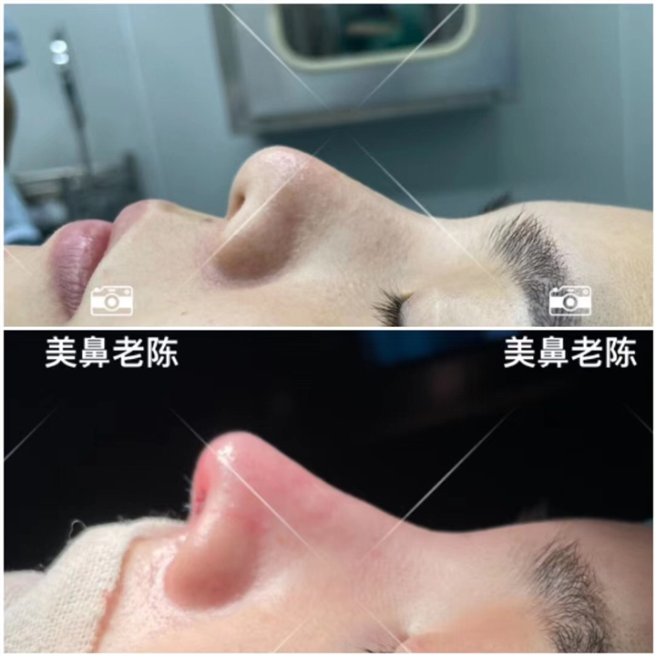 上海鼻王陈坚医生