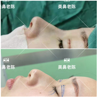 陈坚鼻整形