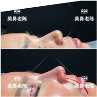 上海陈坚鼻整形