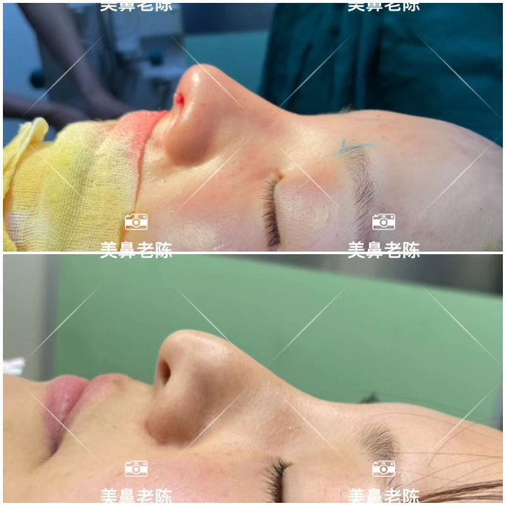 陈坚医生做鼻子怎么样