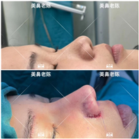陈坚肋骨鼻整形