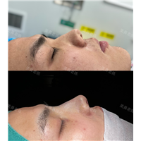 男士鼻综合打造术后即刻