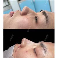 男士鼻综合整形案例