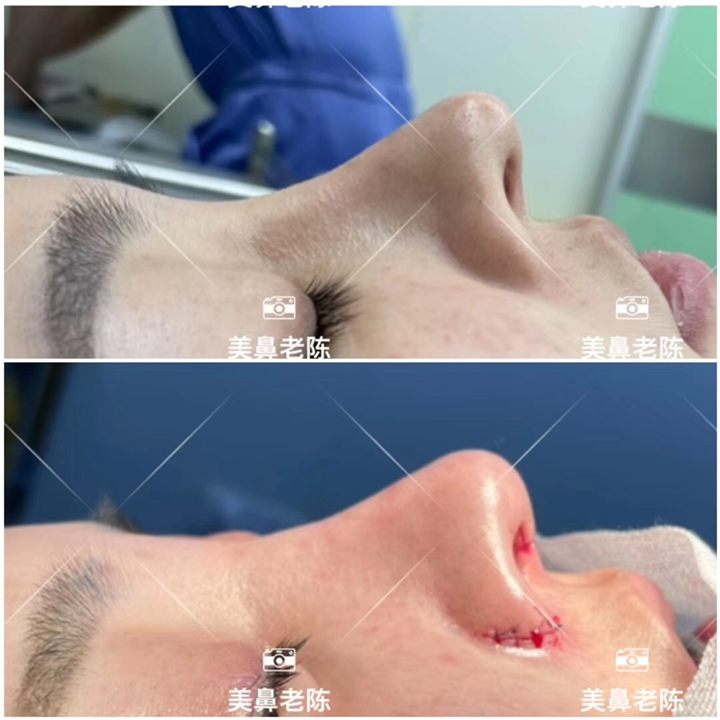 上海肋骨鼻修复医生
